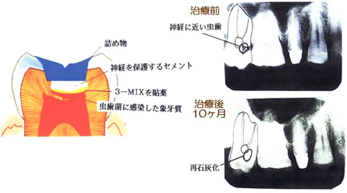 新しい虫歯治療法3MIX-MP法