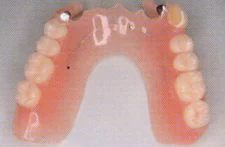 患者さんが喜ぶ第三の義歯