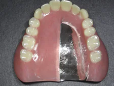 金属床義歯について