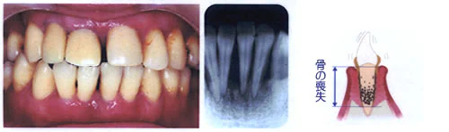 重度歯周炎