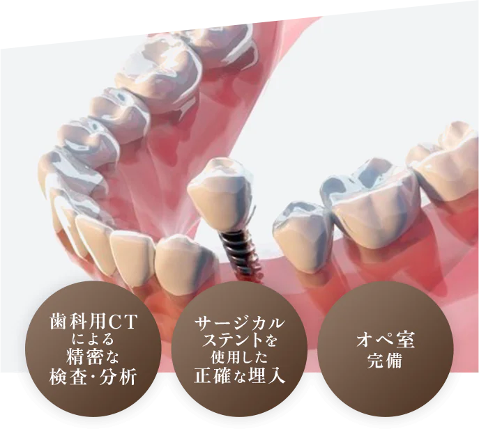 歯科用CT による精密な検査・分析 サージカルステントを使用した正確な埋入 オペ室完備